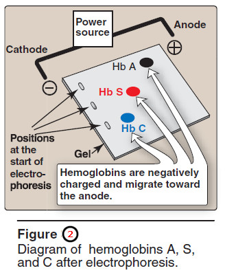 Hemoglobinopathies