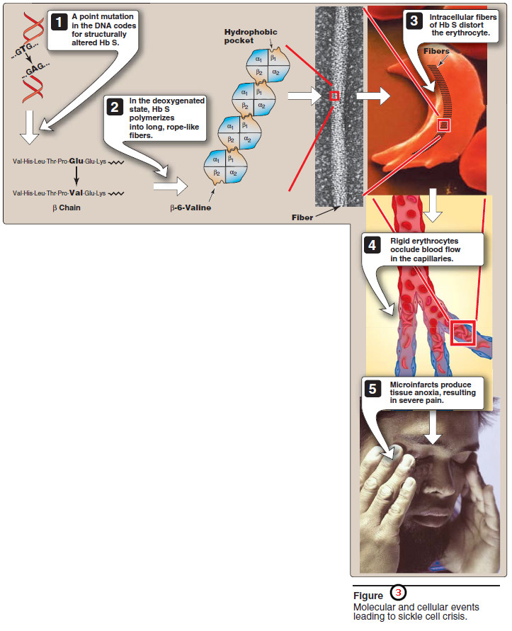 Hemoglobinopathies